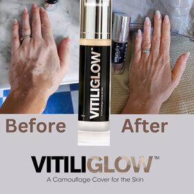 VITILIGLOW® announces partnership with The Vitiligo Society!